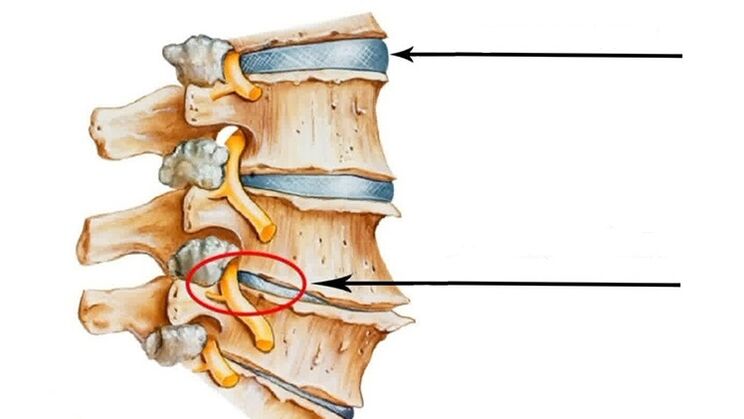 ruggenmergletsel bij cervicale osteochondrose