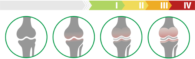 Klinische stadia van artrose van het kniegewricht (mate van artrose van het kniegewricht)