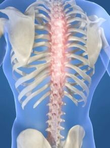 spinale laesie in geval van thoracale osteochondrose