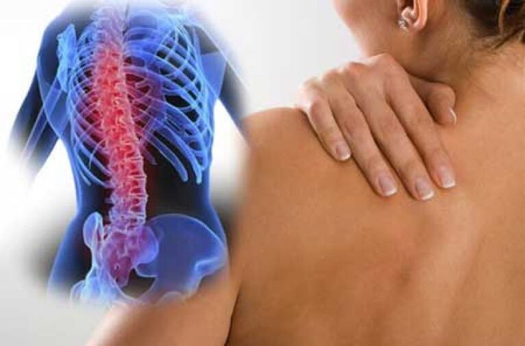 Tijdens een exacerbatie van osteochondrose van de thoracale wervelkolom treedt dorsago-pijn op
