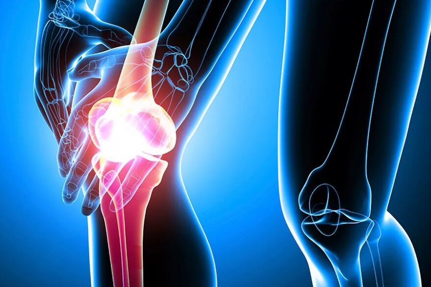 Arthrose van de knie