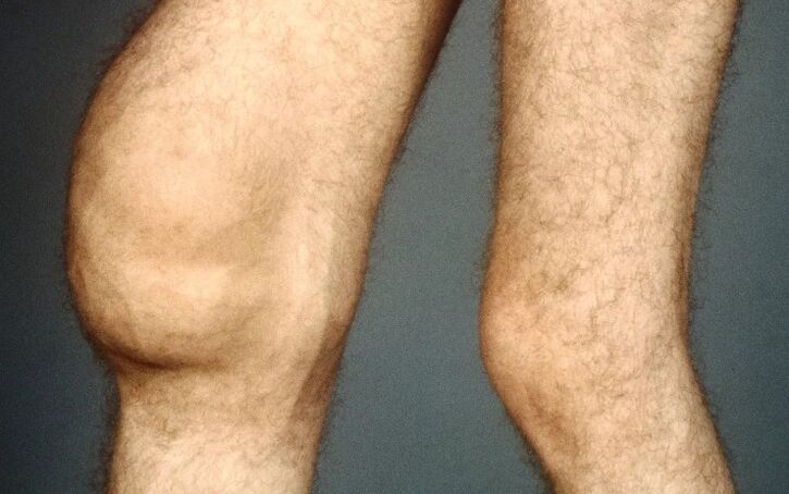 Post -traumatische artrose van het kniegewricht