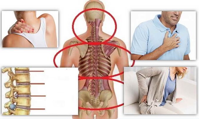 Ziekten voor osteochondrose