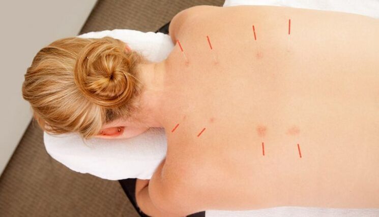 Acupunctuur voor thoracale osteochondrose, wat veel voordelen heeft