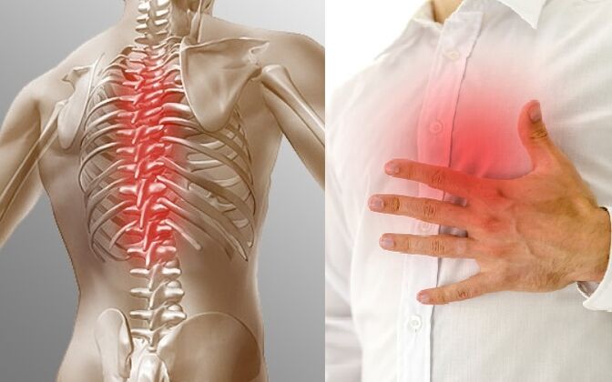 Thoracale osteochondrose manifesteert zich door pijn en een gevoel van beklemming op de borst